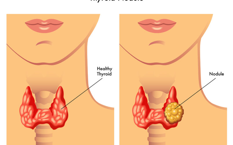 Understanding Thyroid Nodules
