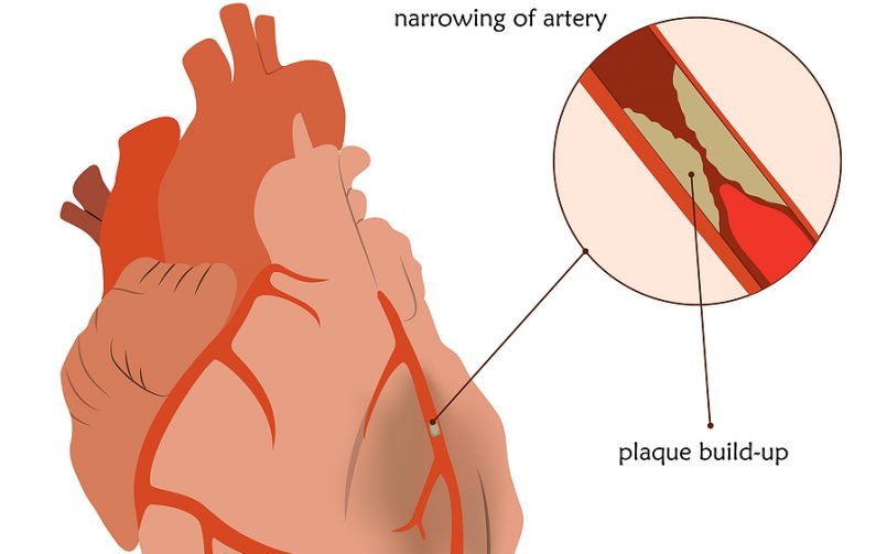 heart with coronary artery disease